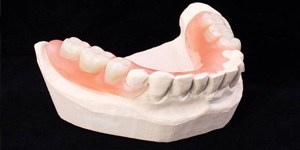 Partial denture on smile model