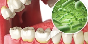 Harmful bacteria around the gum line