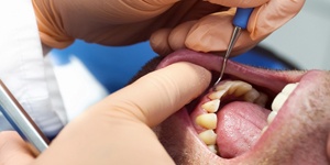 A man having his gums and teeth cleaned