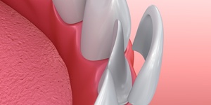 Image of a veneer being place on a front tooth